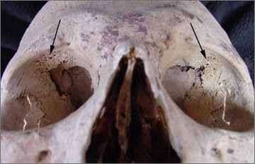 Figure 35. Cribra orbitalia on Skull 57 (pointed out by arrows)