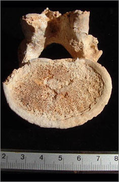 (Fig.4) Thoracic vertebra showing Schmorl’s node where the cartilaginous intervertebral disk (pad between vertebrae) has herniated into the bone