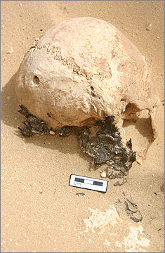 (Fig.4) A well preserved skull exposed in square G51, part of bone cluster (11294), with both teeth and plaited hair remaining 
